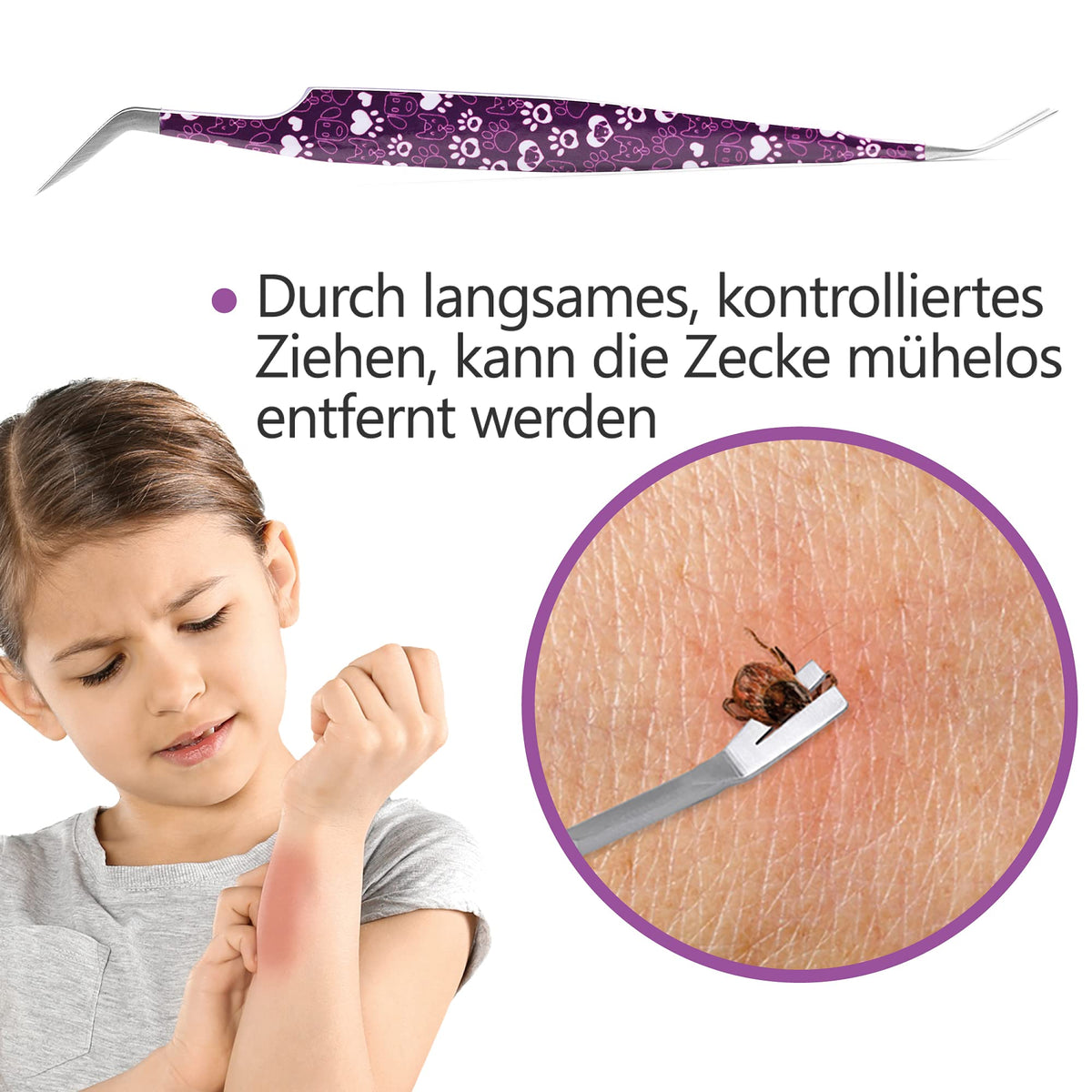 2-in-1 Profi Zeckenzange - für Hunde und Katzen - Violett zum sicheren und einfachen Entfernen von Zecken durch langsames, kontrolliertes Ziehen.